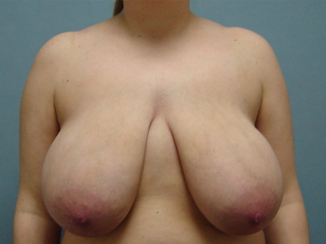 breast reduction patient