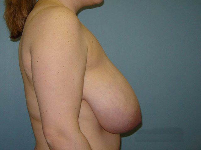 breast reduction patient
