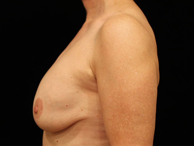 breast revision patient