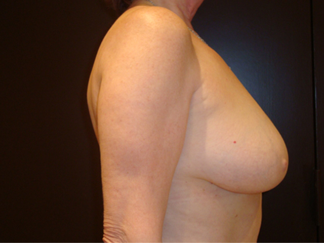 breast revision patient