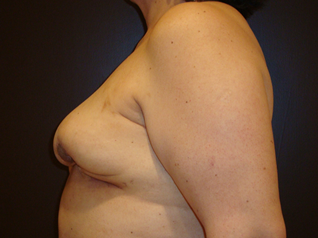 breast revision patient