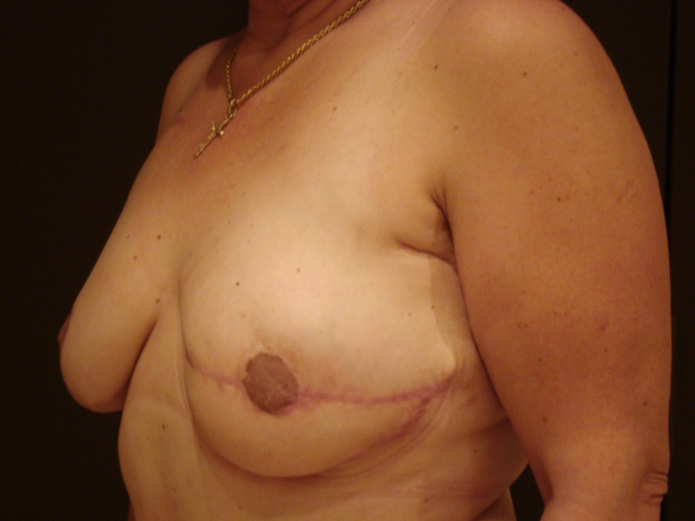 breast revision patient