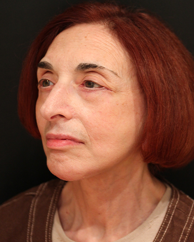 facelift patient