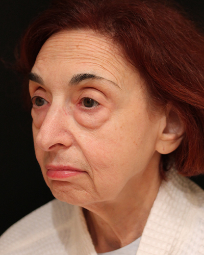facelift patient