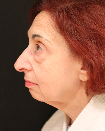 facelift patient
