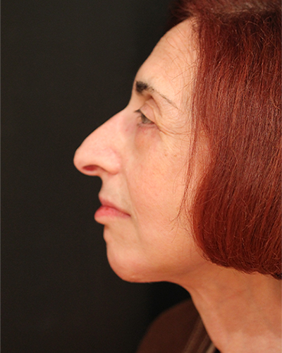 facelift patient