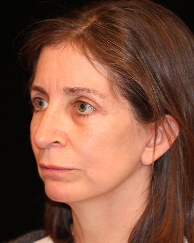 facelift patient
