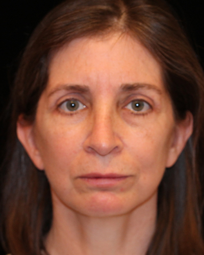 facelift patient