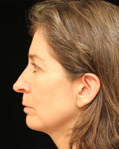 facelift patient