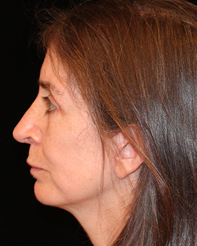 facelift patient