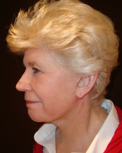 facelift patient