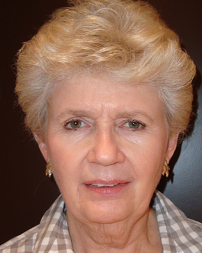 facelift patient