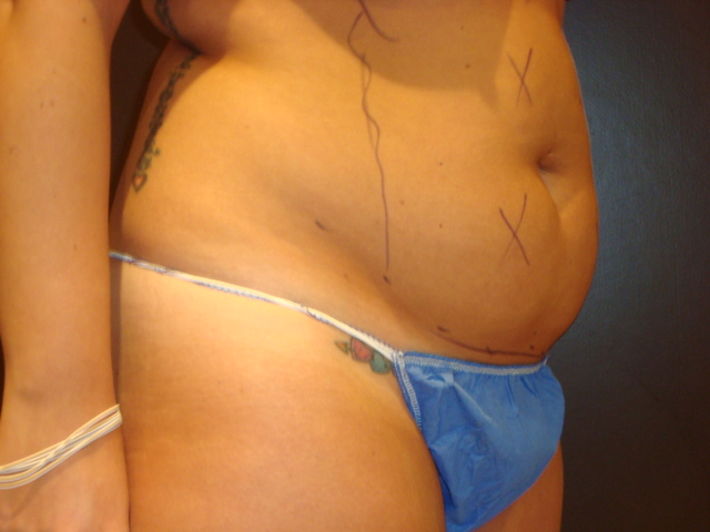 liposuction patient