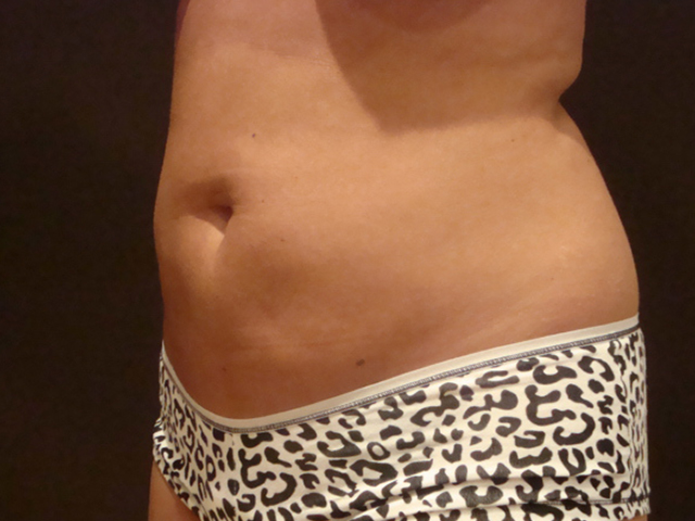 liposuction patient