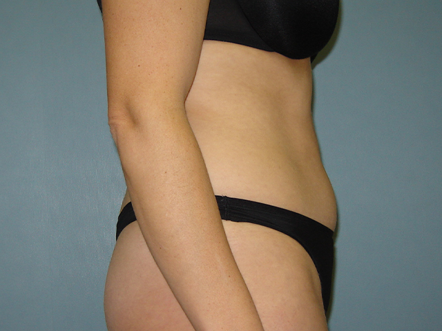 liposuction patient