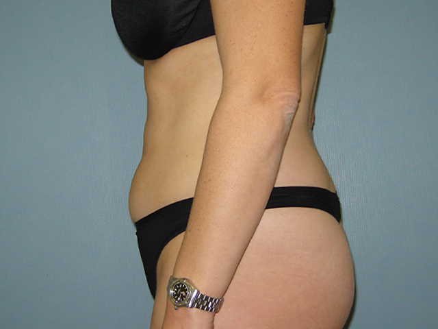 liposuction patient