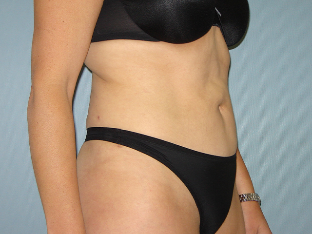 liposuction patient