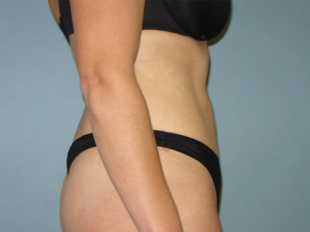liposuction patient