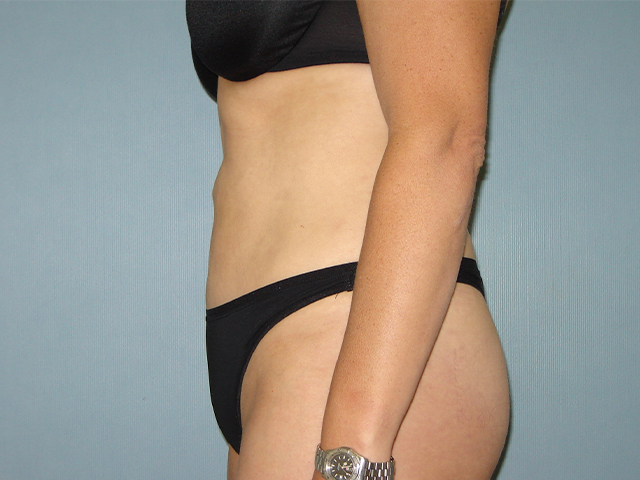 liposuction patient