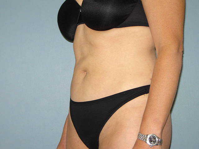 liposuction patient