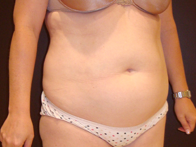 liposuction patient