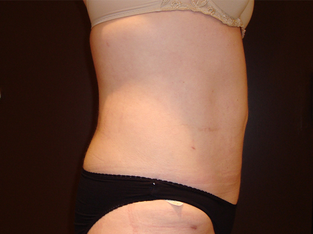 liposuction patient