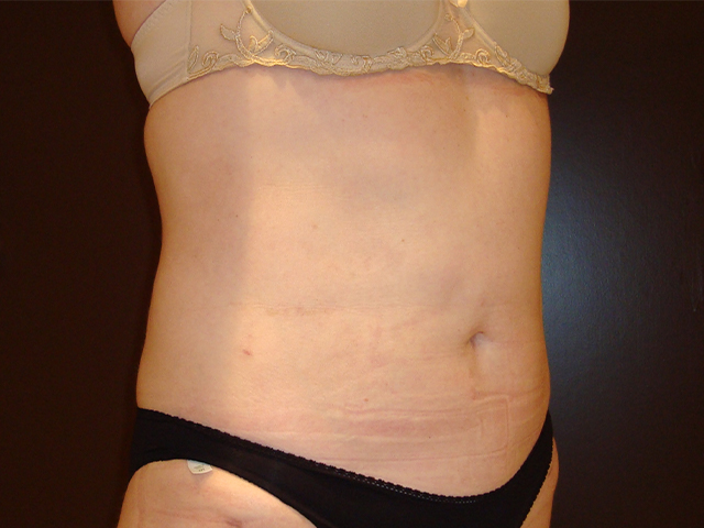 liposuction patient