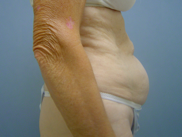 liposuction patient
