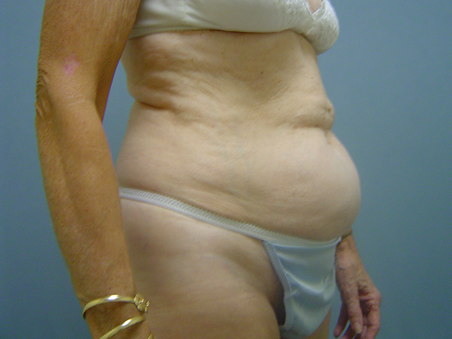 liposuction patient