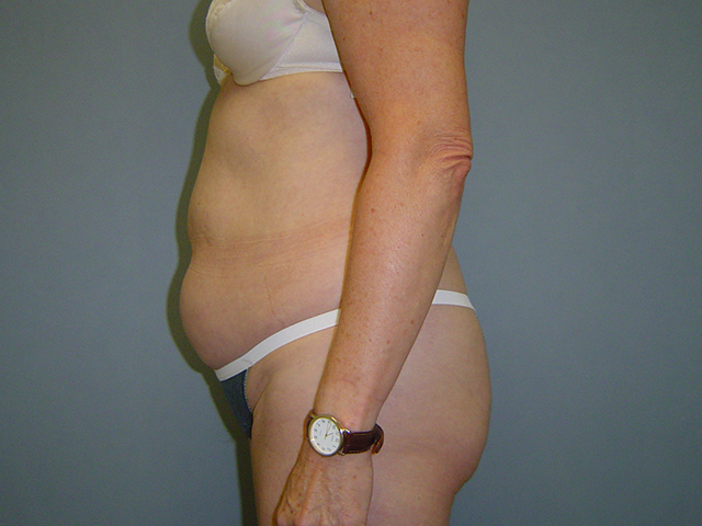 liposuction patient