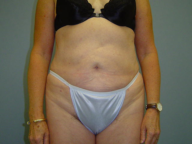 liposuction patient