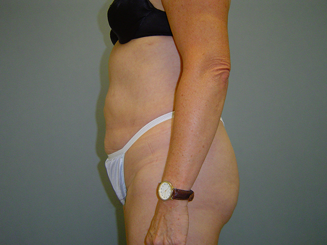 liposuction patient