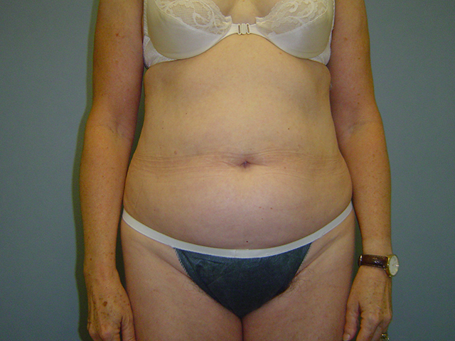 liposuction patient