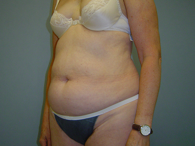 liposuction patient