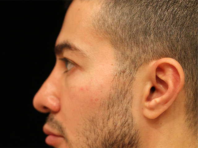 male blepharoplasty patient