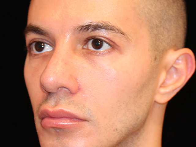 male blepharoplasty patient