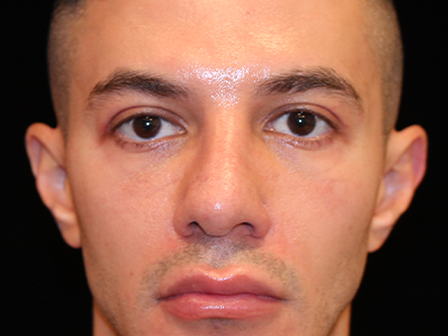 male blepharoplasty patient