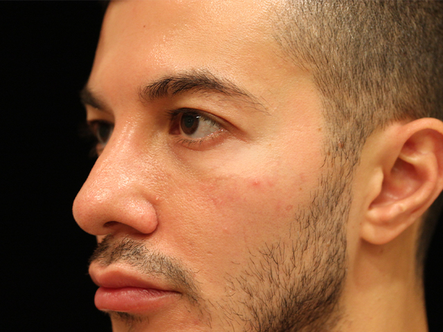 male blepharoplasty patient