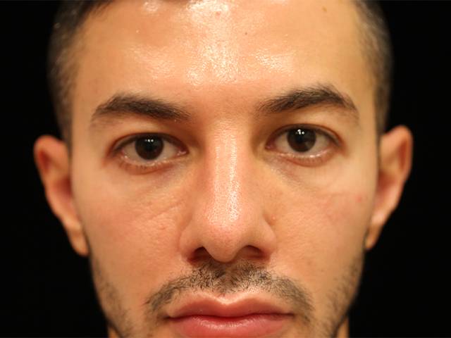 male blepharoplasty patient
