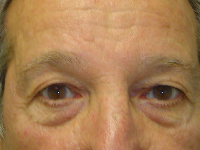 male blepharoplasty patient