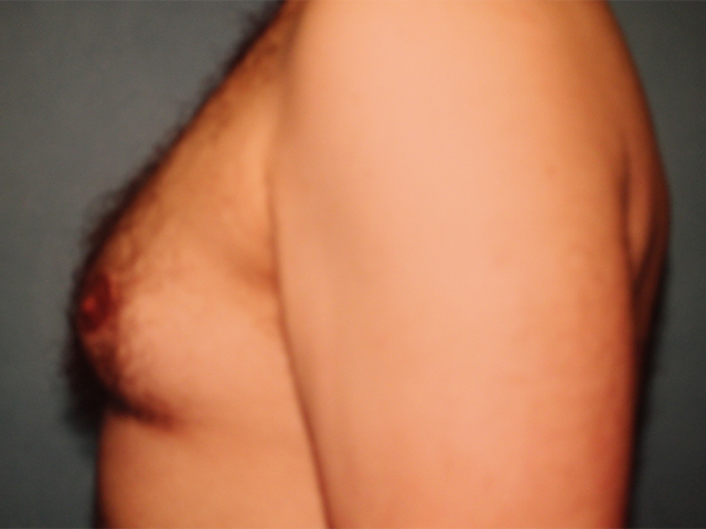 male breast reduction patient