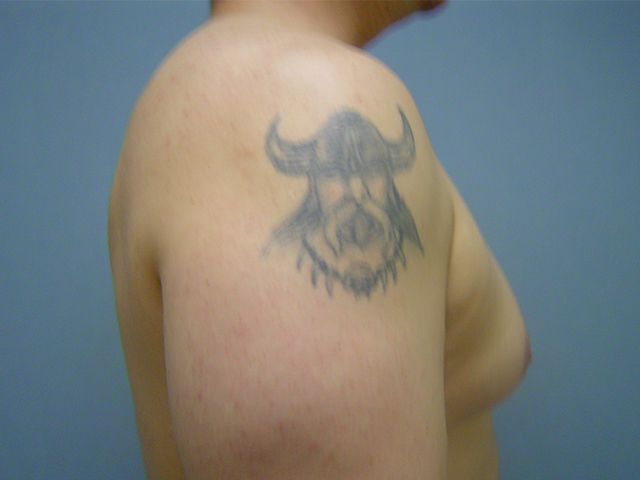 male breast reduction patient