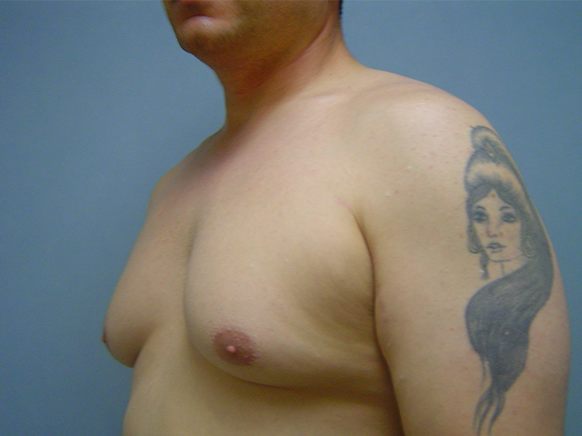 male breast reduction patient