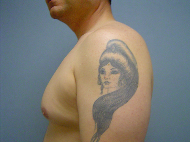 male breast reduction patient