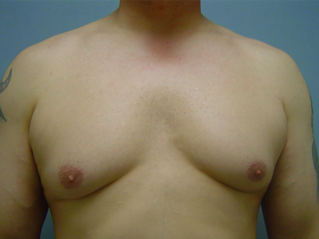 male breast reduction patient