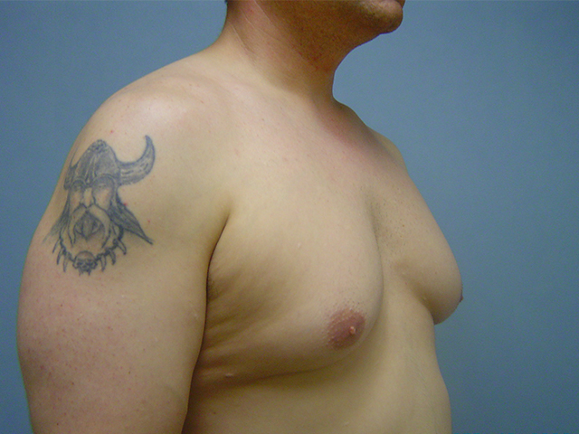 male breast reduction patient