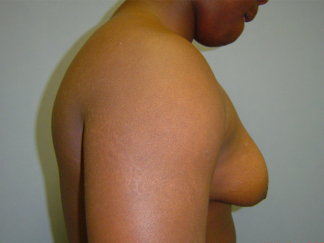 male breast reduction patient