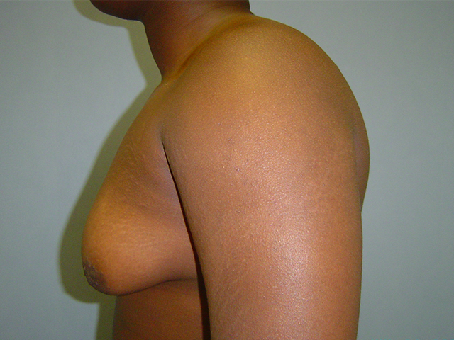 male breast reduction patient
