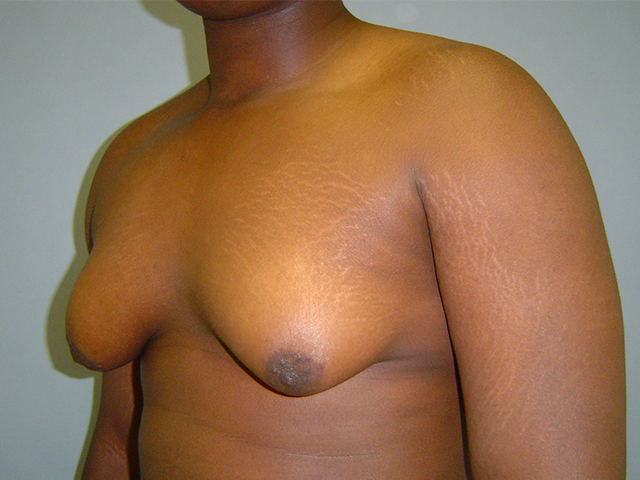 male breast reduction patient