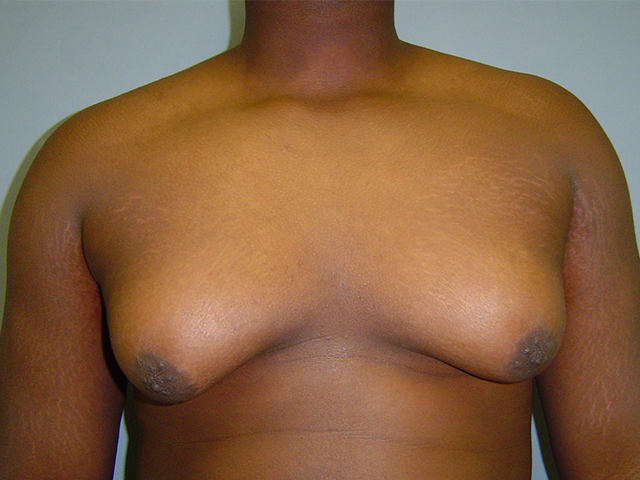 male breast reduction patient